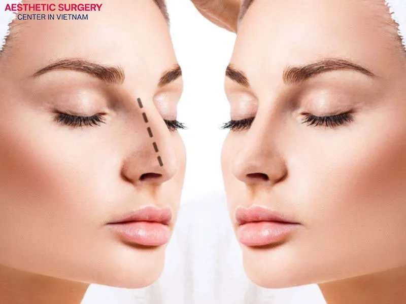 Semi-structural rhinoplasty offers many outstanding advantages at an affordable price