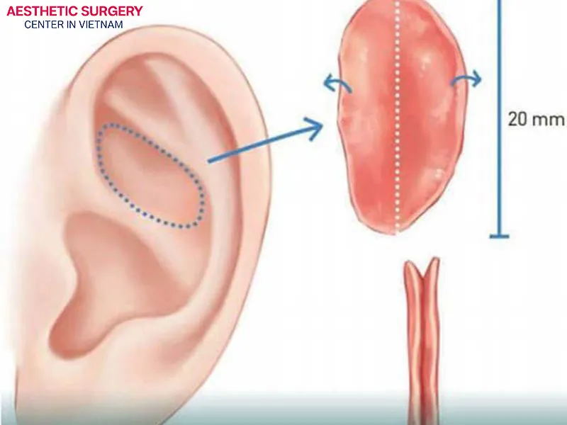 Premium cartilage materials such as autologous cartilage are more expensive than standard synthetic options