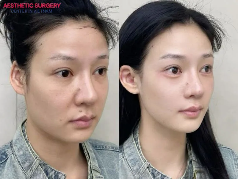 The nasal bridge is higher, straighter, and more refined, creating a harmonious and attractive facial appearance