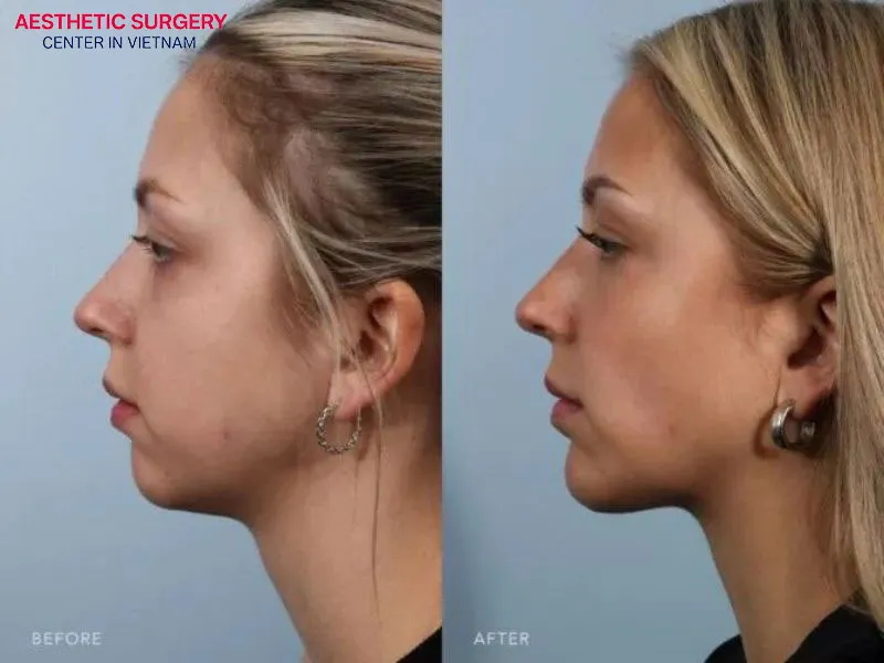 The nasal tip is well-defined, with no signs of a flat or under-projected nose as before