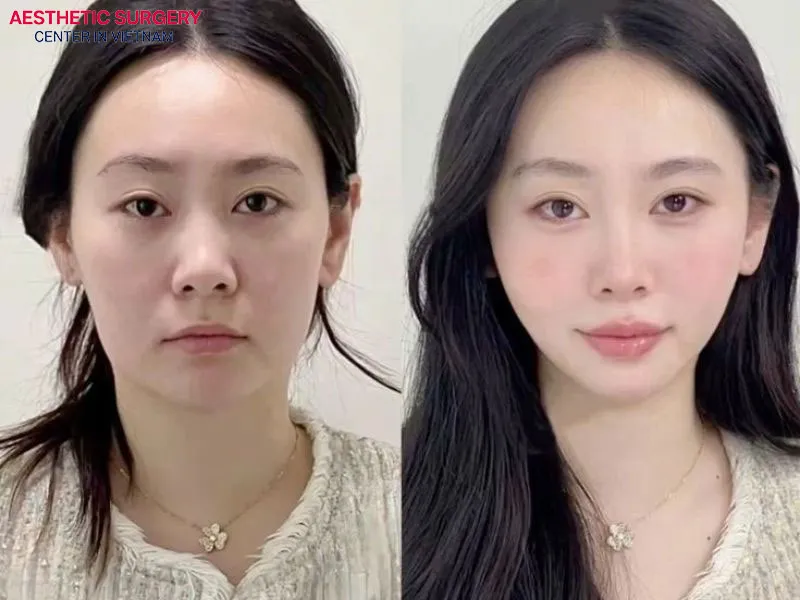 A sharper side profile with the new nose shape gives a youthful and elegant impression