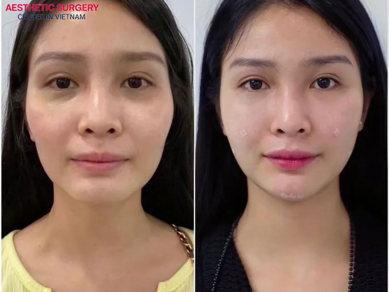 The client’s nose shape appears stable and naturally beautiful after the healing process