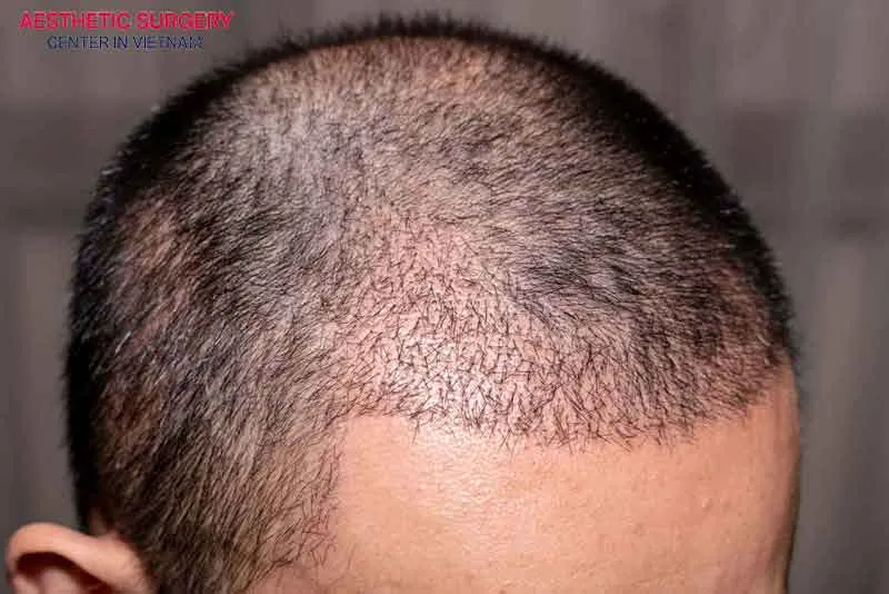 During the mature hair growth phase, the hair grows normally, becomes stronger, thicker, and appears as natural as native hair
