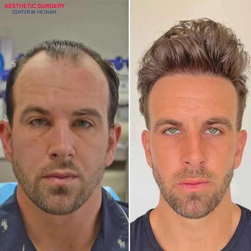 Hair transplant before - after