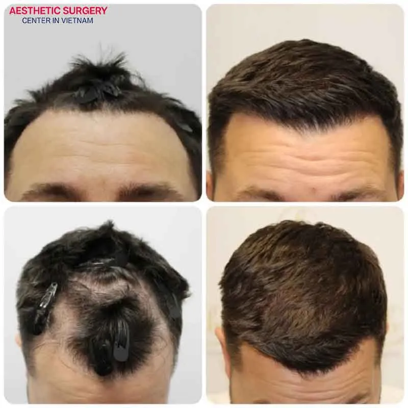 A hair transplant can significantly enhance one’s appearance, which is why it is trusted and used by many clients