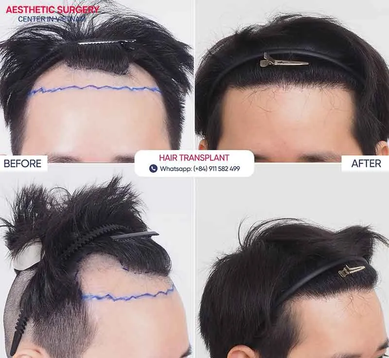 Client results after hair transplant at Aesthetic Surgery Center