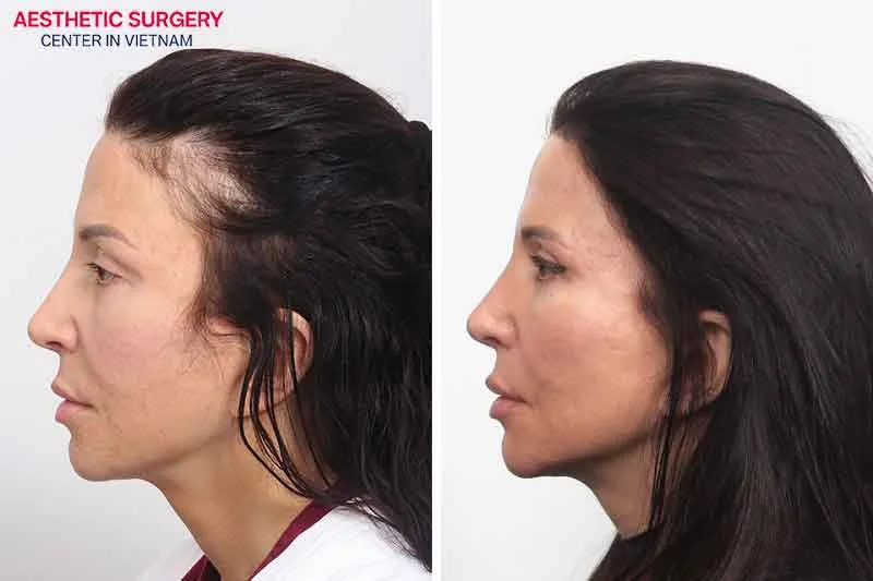 Transplanted hair will grow strong, natural, and full 