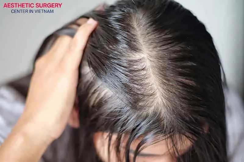 If you're dealing with thinning hair or baldness, you may consider a hair transplant in Vietnam