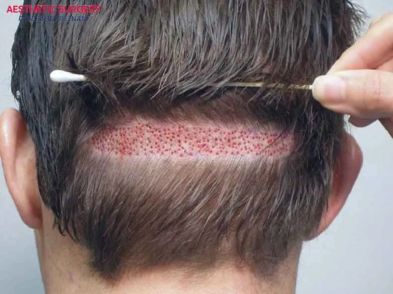 Donor hair follicles are usually taken from the back of the head or both temples