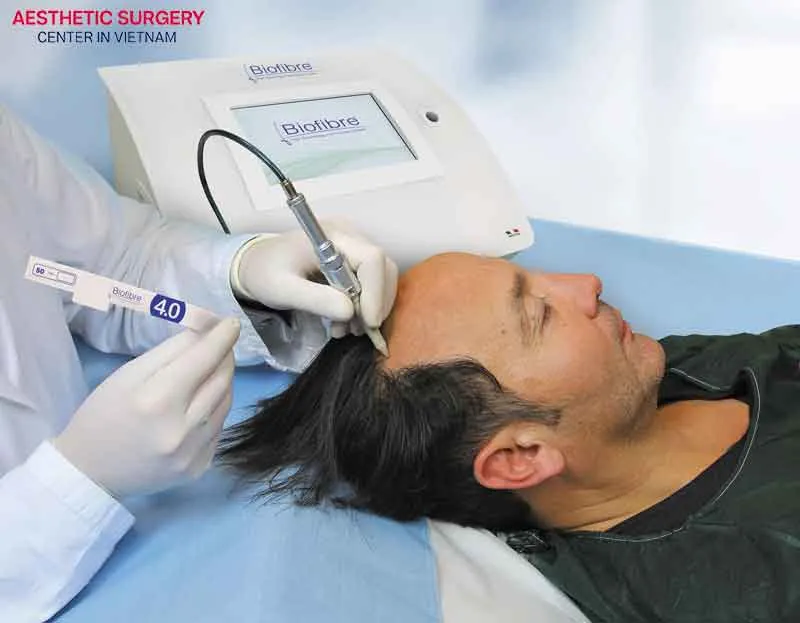 Artificial hair transplant is a method that uses artificial hair strands implanted into thinning or balding areas of the scalp