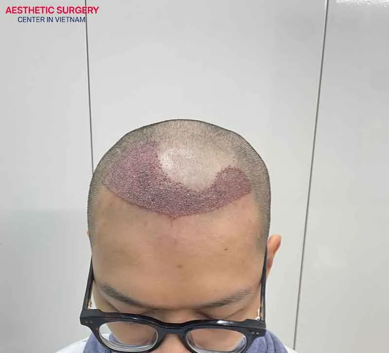 In the first weeks after the transplant, the scalp often experiences swelling and scabbing