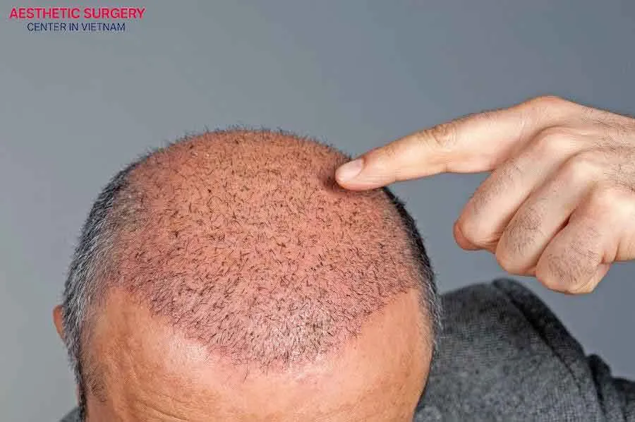 After 3–6 months, most areas have visible regrowth, and hair begins to grow longer