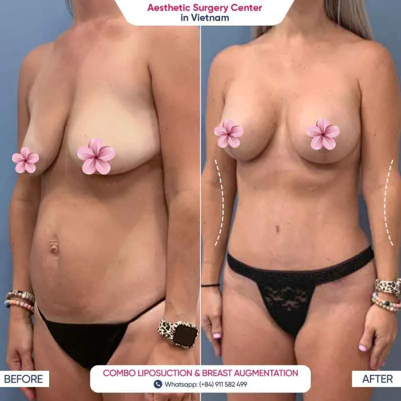 The client’s breasts were significantly improved after breast augmentation at the Aesthetic Surgery Center in Vietnam