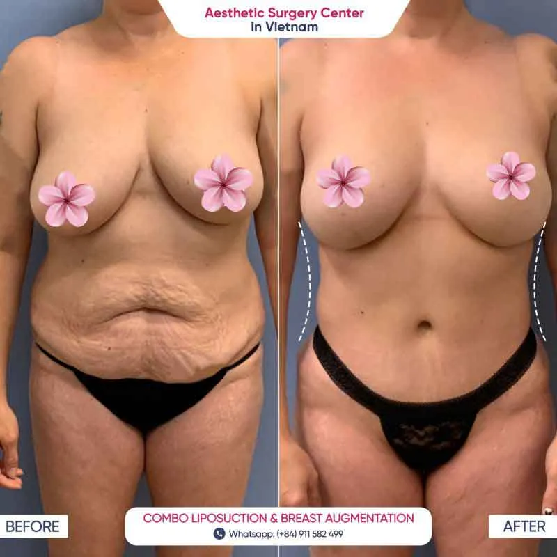 The bust became firmer, more elastic, and more attractive after breast augmentation at the Aesthetic Surgery Center in Vietnam