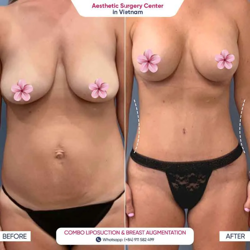 The bust size is significantly enhanced after breast augmentation at the Aesthetic Surgery Center in Vietnam