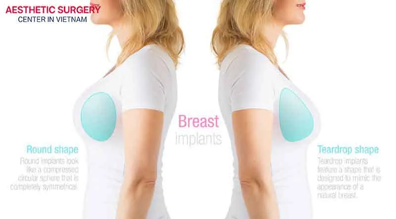 Round and teardrop-shaped implants typically create different breast shapes, but both enhance the bust’s aesthetics 