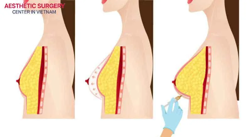 Fat transfer breast augmentation is performed by harvesting fat from other areas of the body and directly injecting it into the breasts