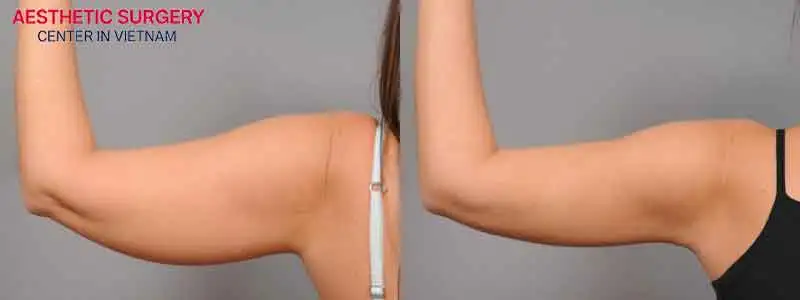 Is Arm liposuction worth it? With its minimally invasive nature, quick results, and noticeable aesthetic improvement, Liposuction of the arms is definitely worth considering.