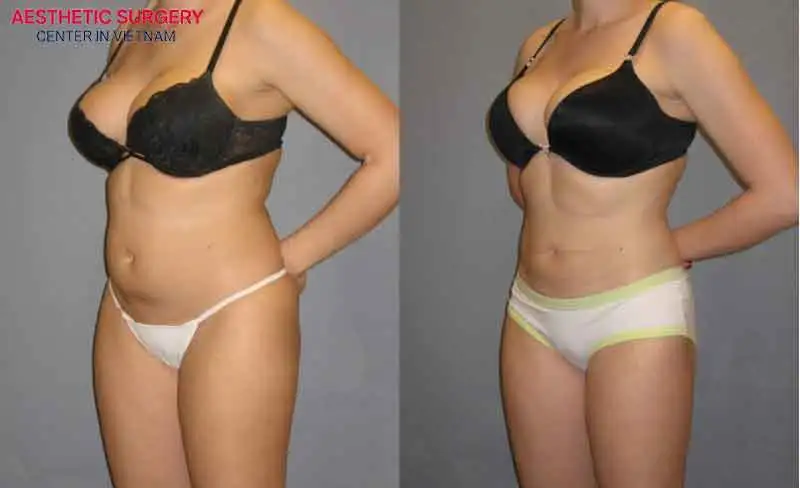 The waist becomes firmer and slimmer after abdominal liposuction.
