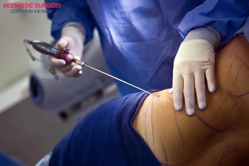 Liposuction helps eliminate excess fat and gives you a more toned, sculpted body