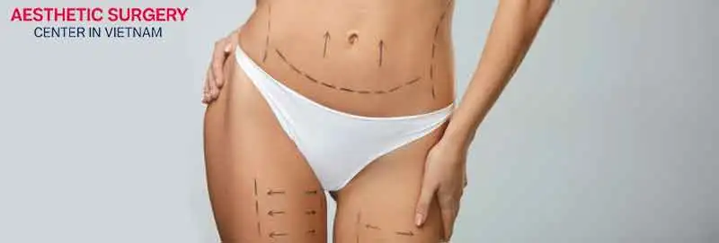 Liposuction is recommended for healthy adults over 18