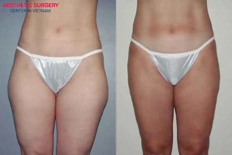 Thigh fat is significantly reduced after liposuction, restoring slim and smooth legs.