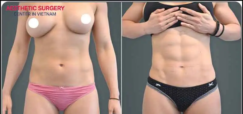 After liposuction, the waistline becomes tighter and more defined, helping women feel more confident in form-fitting outfits.