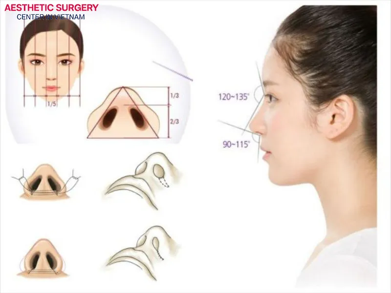 Each rhinoplasty method has its own advantages and limitations