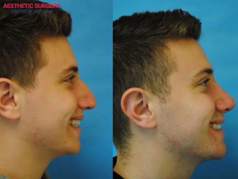 The client’s nose shape shows clear improvement after rhinoplasty