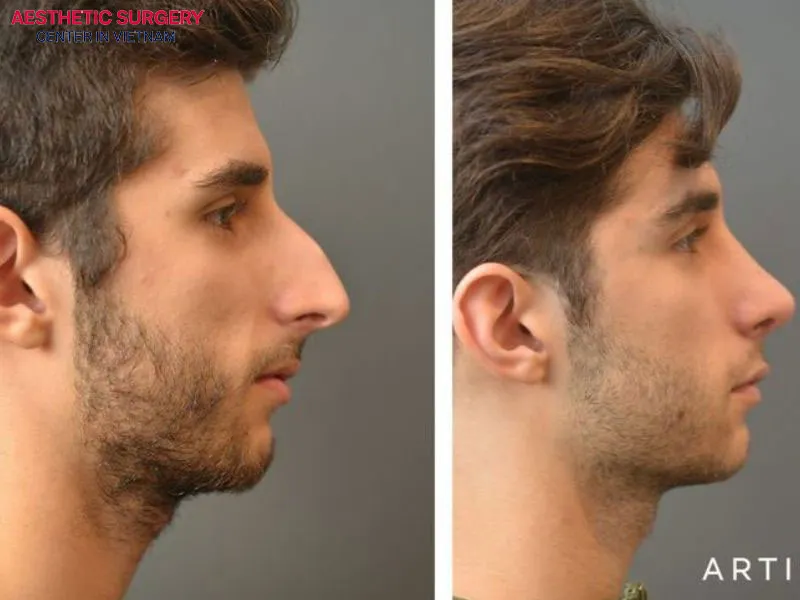 Clients confidently show off their new look after rhinoplasty