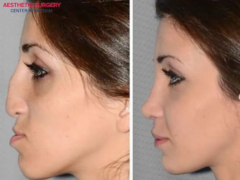 The client is extremely satisfied with her new nose shape