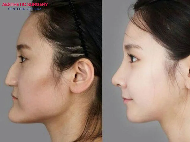 Before-and-after rhinoplasty images from a client