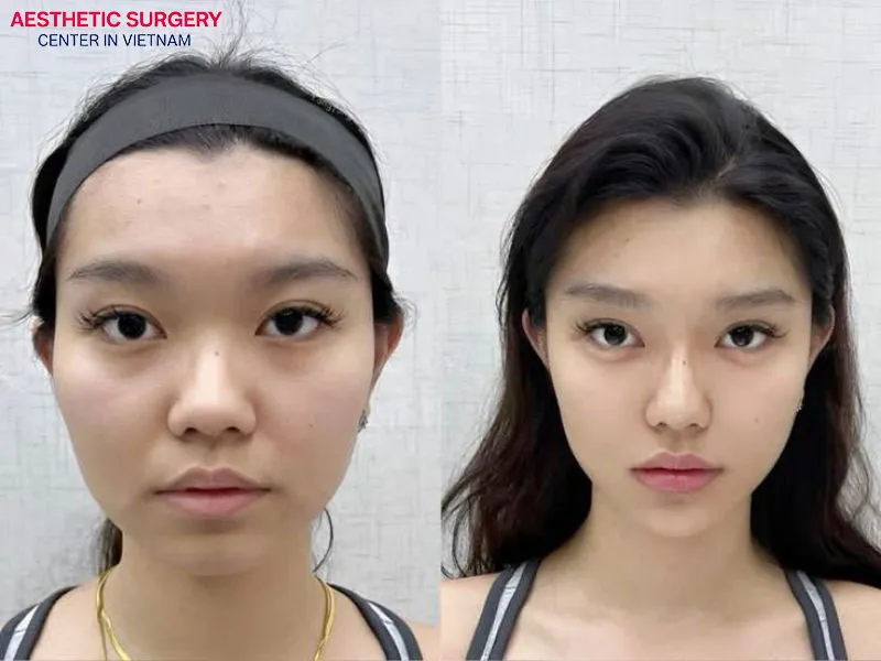 A high, refined nose shape 1 month after surgery