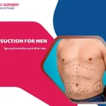 Liposuction for men