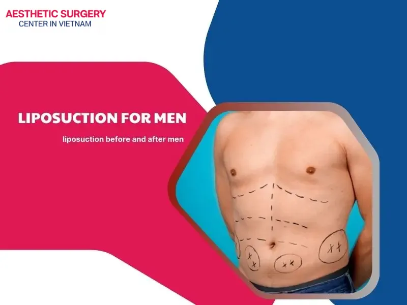Liposuction for men