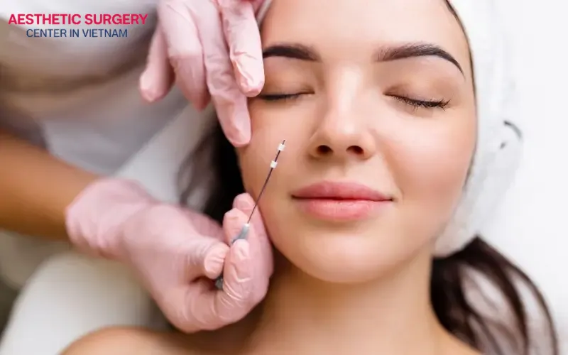 Thread lift rhinoplasty uses absorbable bio-threads to effectively shape the nose
