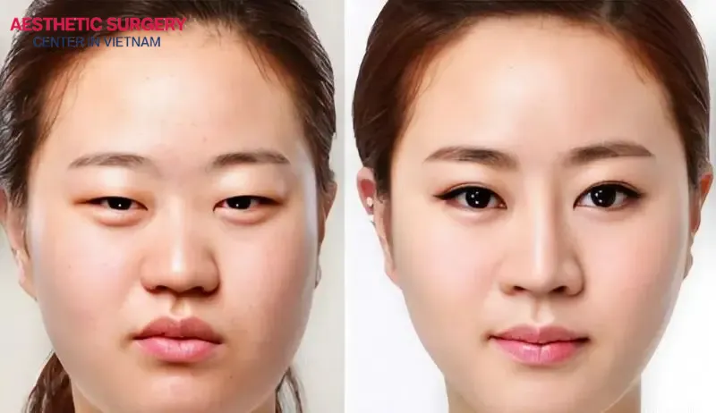 Choose your clinic and surgeon carefully to achieve the desired double eyelid results