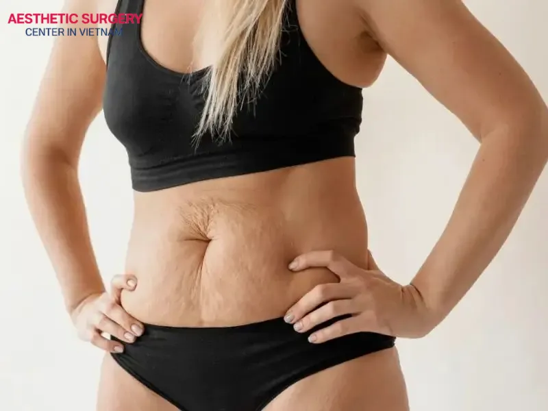 A botched liposuction procedure can cause skin deformities and visible imbalances, affecting the body’s aesthetics