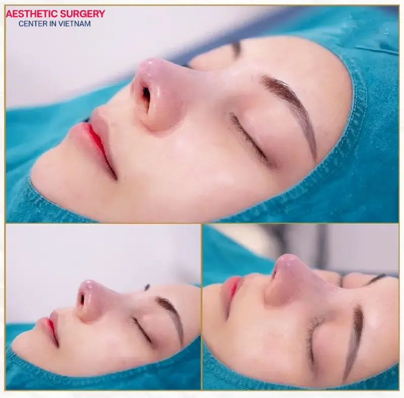 Semi-structural rhinoplasty uses an artificial implant to raise the nasal bridge and refines the nasal tip using autologous cartilage