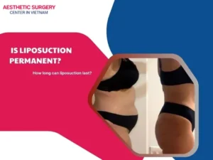 Is liposuciton permanent