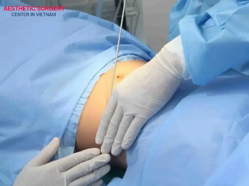 Understanding and applying these critical precautions will help you avoid botched liposuction