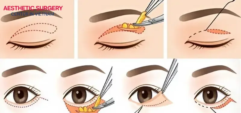 Eyelid procedure is chosen depending on each person's condition and needs