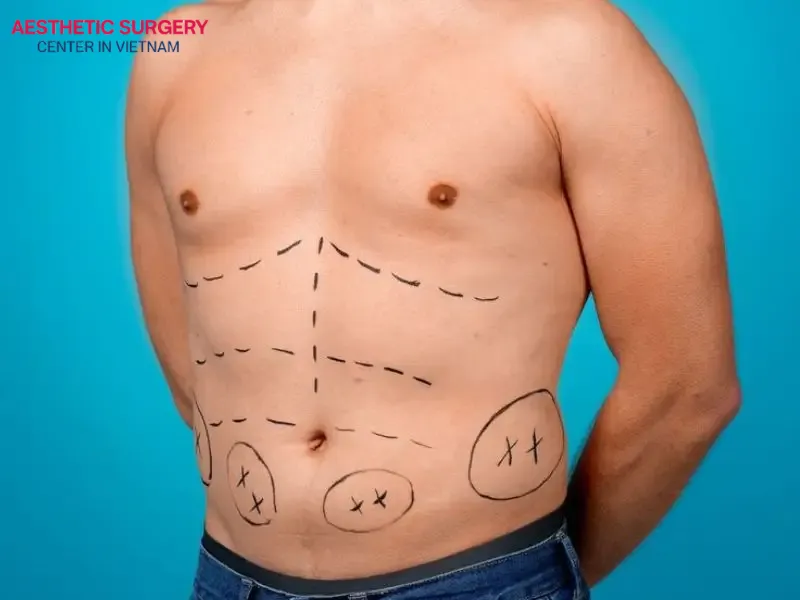 Liposuction for men helps eliminate excess fat quickly