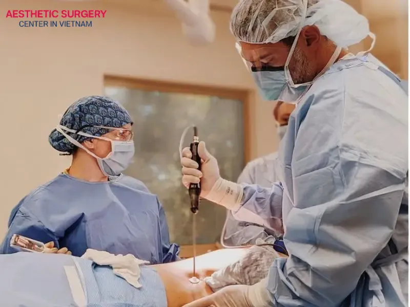 Liposuction removes fat permanently from the treated areas