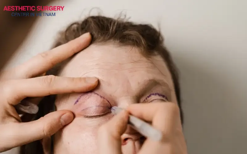 Upper blepharoplasty effectively removes excess skin and sagging fat from the upper eyelid area