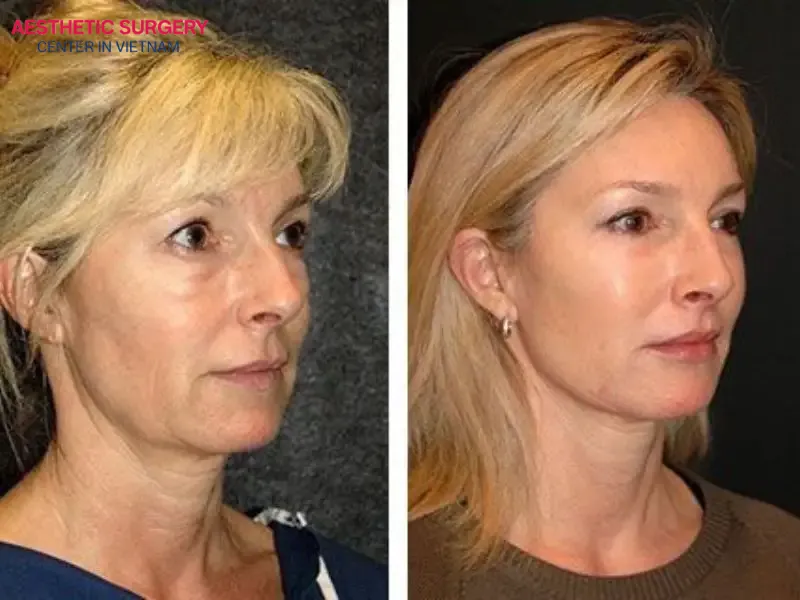 From 30 days after your facelift, you can resume normal daily activities and work