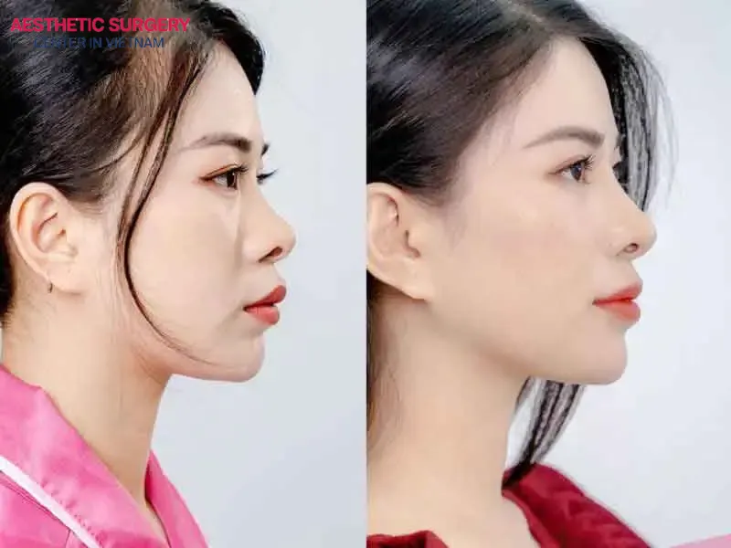 Aesthetic Surgery Center is a trusted open rhinoplasty clinic in Vietnam, chosen by thousands of satisfied clients