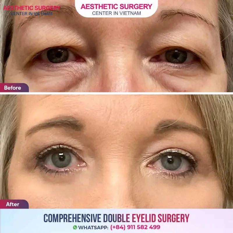 The sagging eyelids caused by aging have been significantly improved through blepharoplasty at Aesthetic Surgery Center