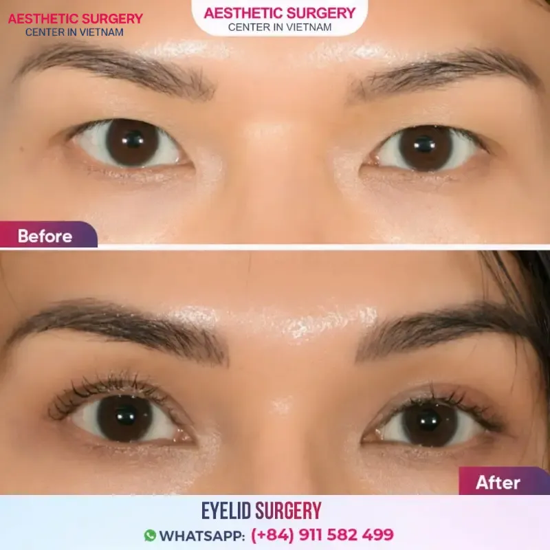 Before and after images of a client undergoing blepharoplasty at Aesthetic Surgery Center
