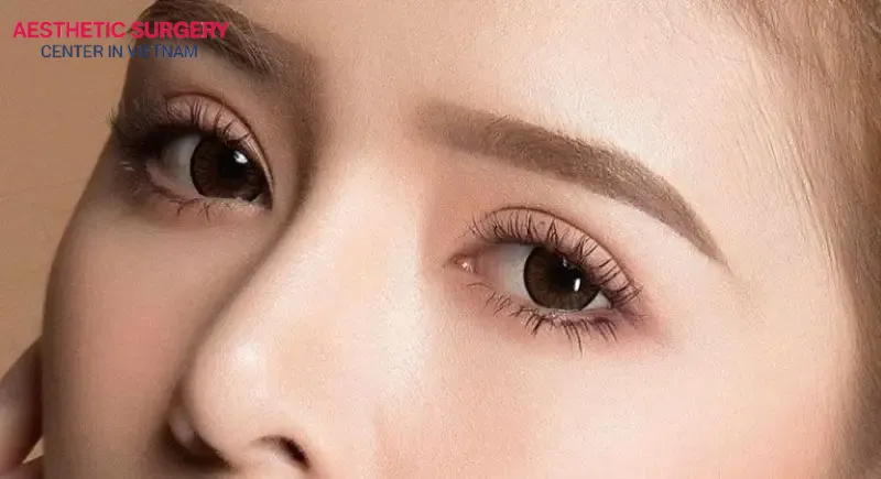 Depending on the condition of the eyelids and the client’s aesthetic preferences, a different eyelid surgery method will be recommended